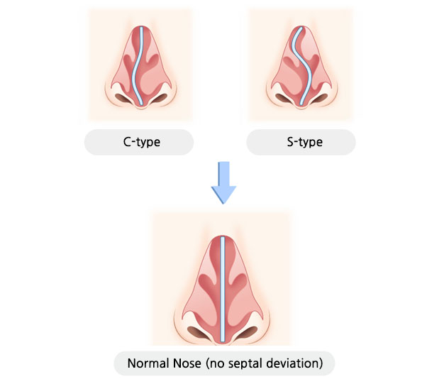 Deviated Nasal Septum