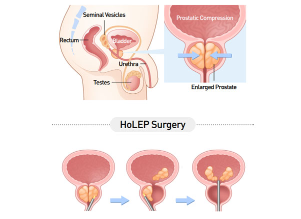 Benign Prostatic Hyperplasia
