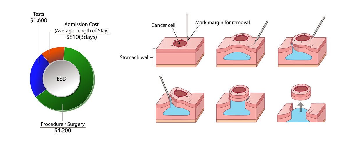 Stomach Cancer