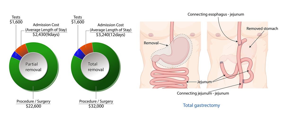 Stomach Cancer