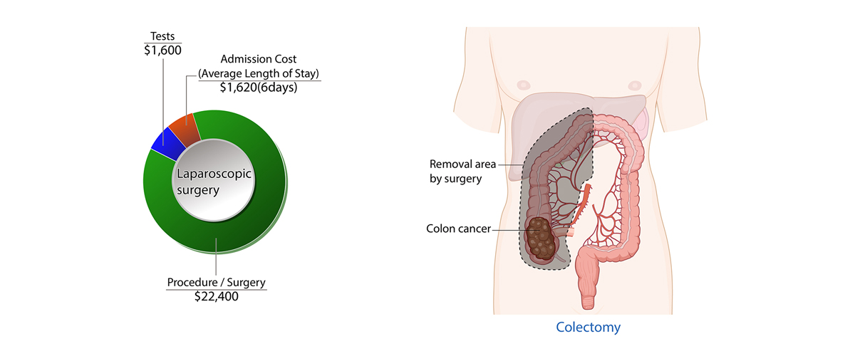 Colorectal Cancer 02