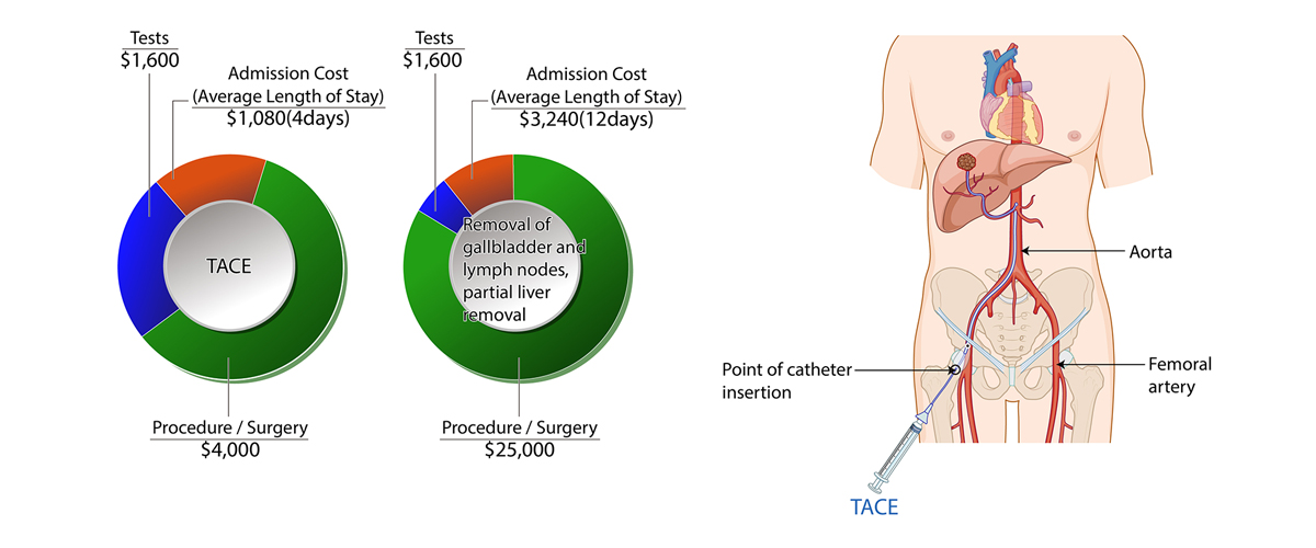 Liver Cancer