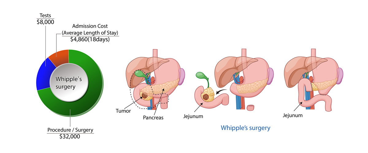 Pancreatic Cancer