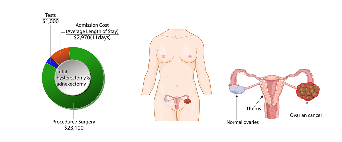 Ovarian Cancer