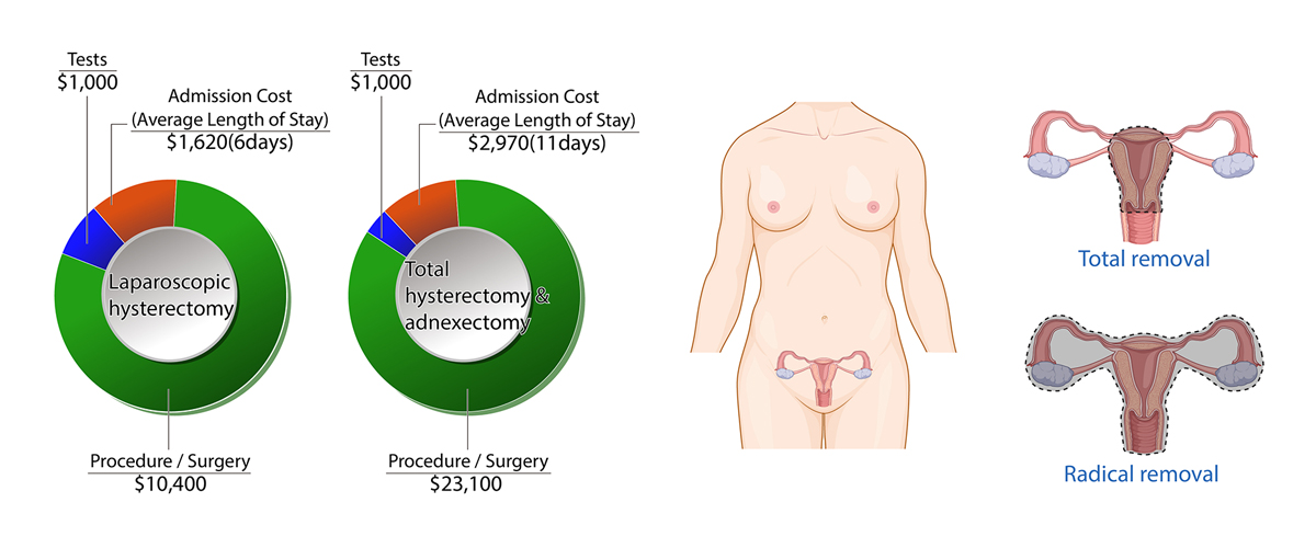 Uterine Cancer