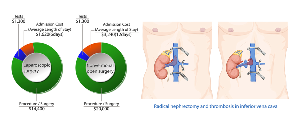 Kidney Cancer