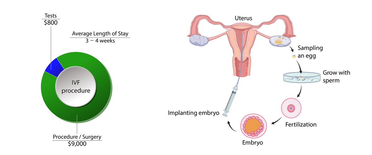 IVF