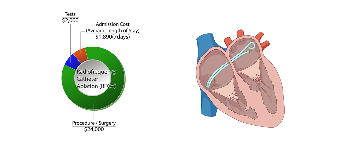 Radiofrequency Catheter Ablation(RFCA)