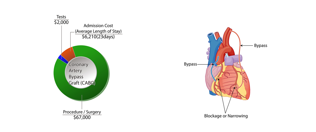 Coronary Artery Bypass Graft (CABG)