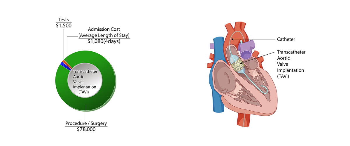 Transcatheter Aortic Valve Implantation(TAVI)