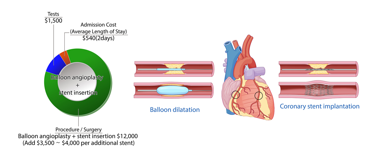 Percutaneous Coronary Internention(PCI)/Coronary Angioplasty