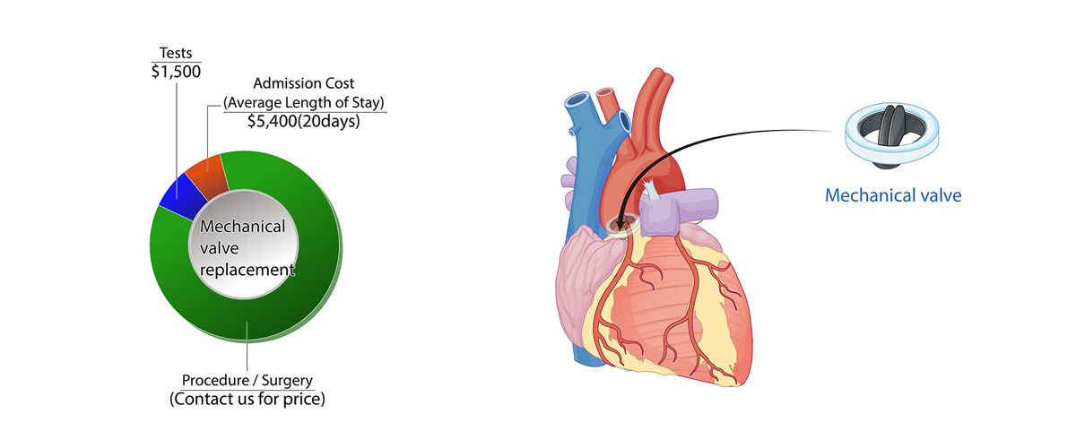 Heart Valve Replacement Surgery