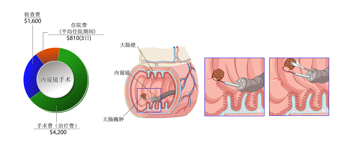 大肠癌