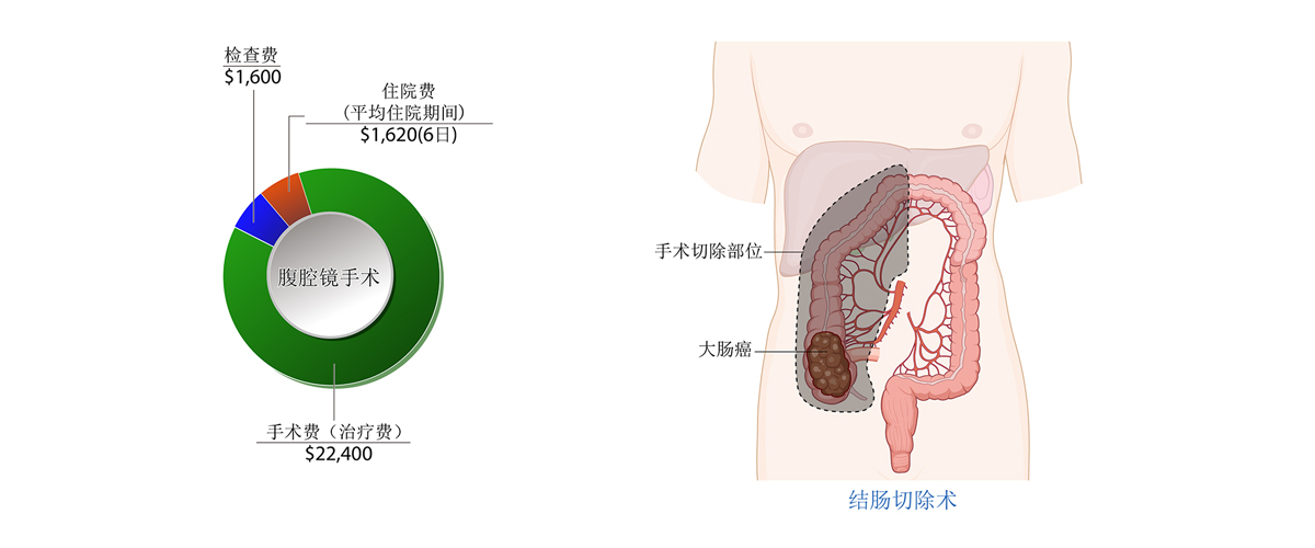 大肠癌