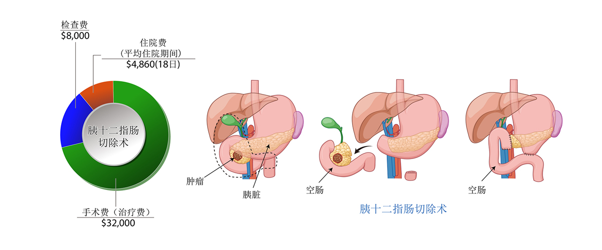 胰腺癌