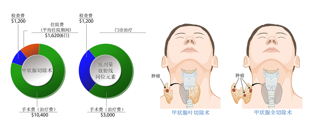 甲状腺癌