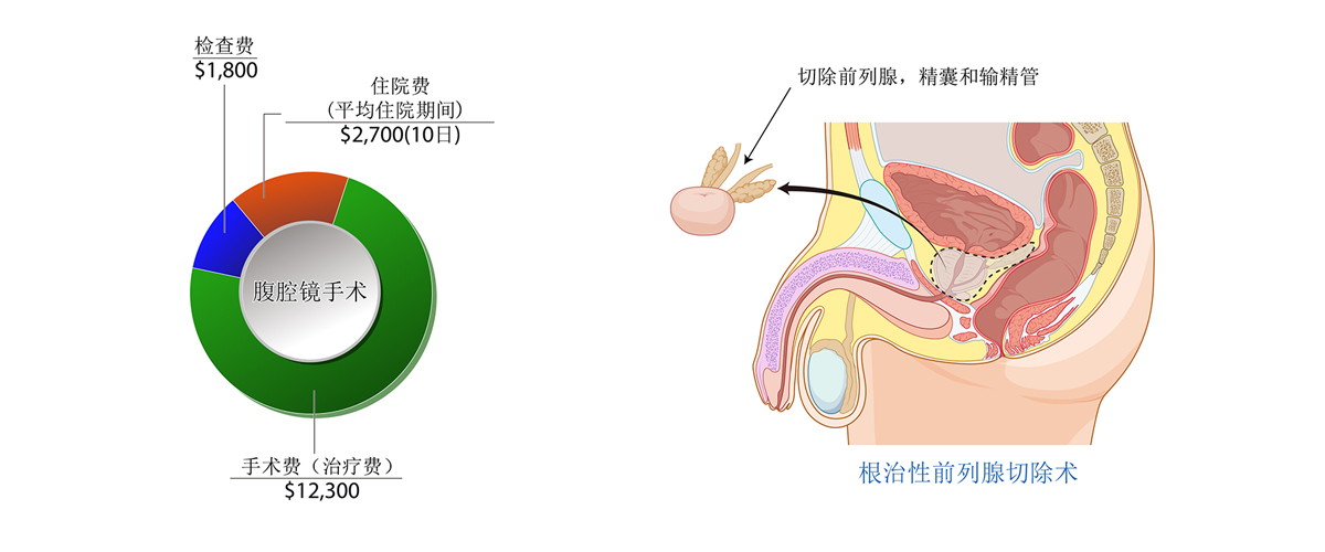 前列腺癌