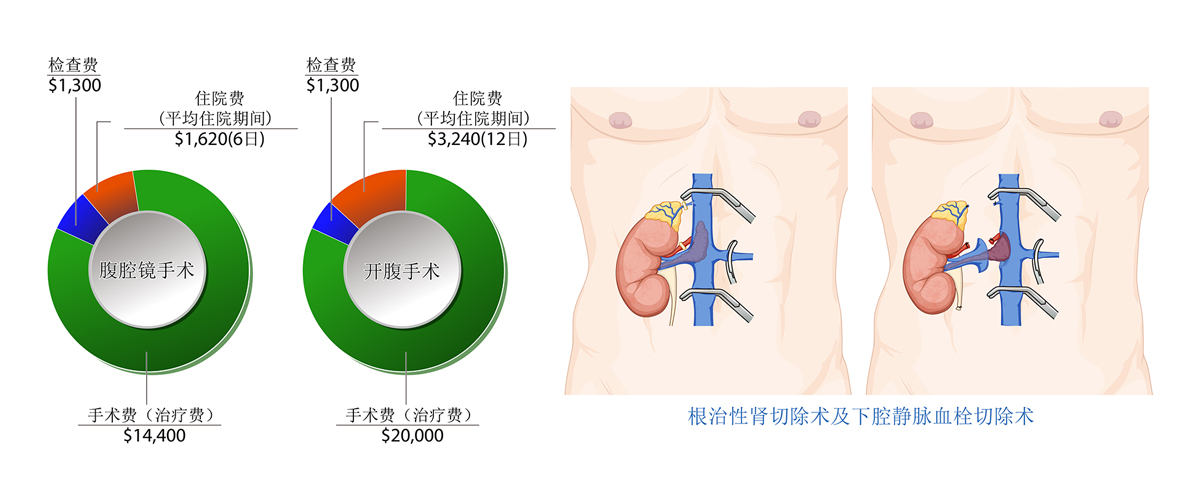 肾癌