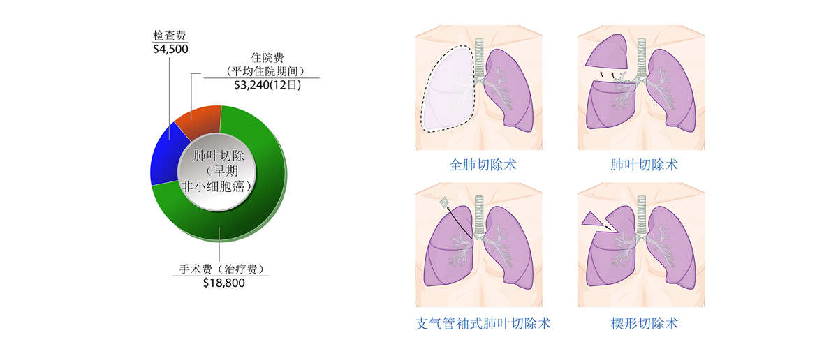 肺癌