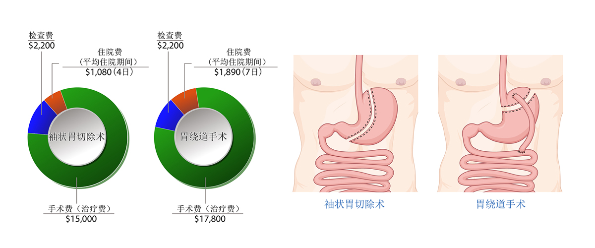 肥胖代谢手术