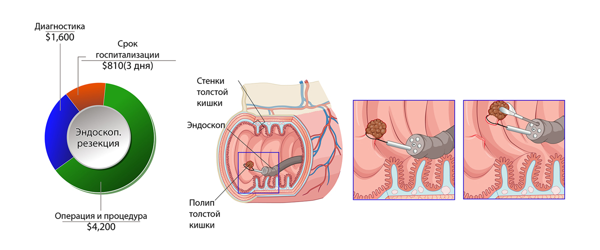 Рак толстой кишки