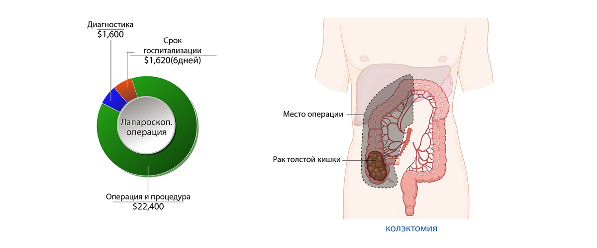 Рак толстой кишки