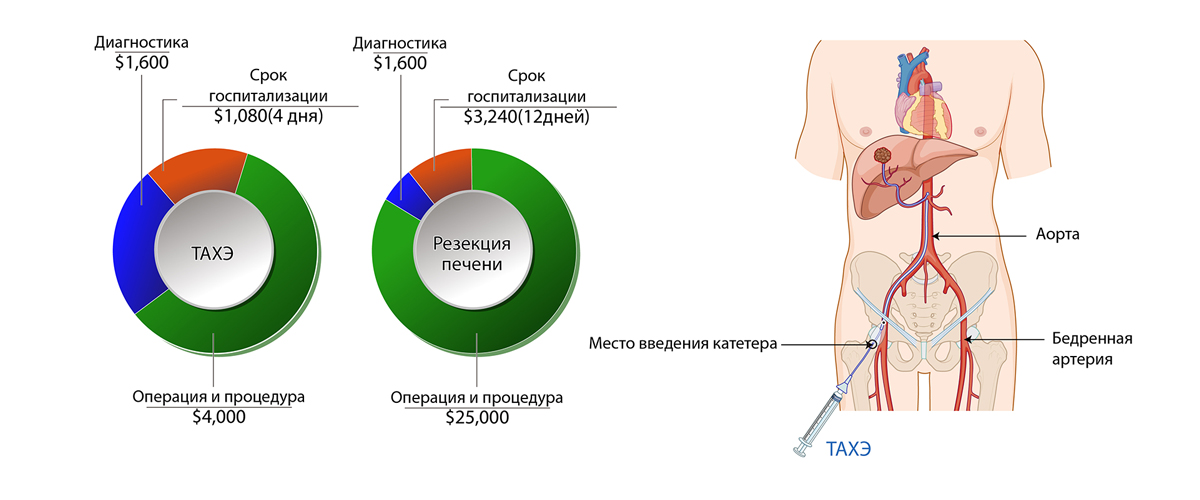 Рак печени