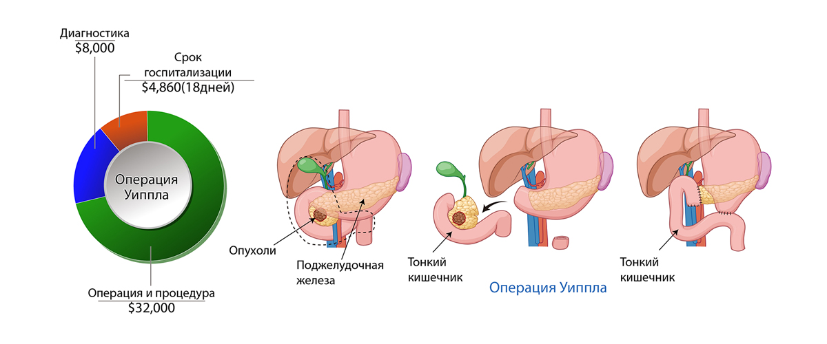 Рак поджелудочной железы