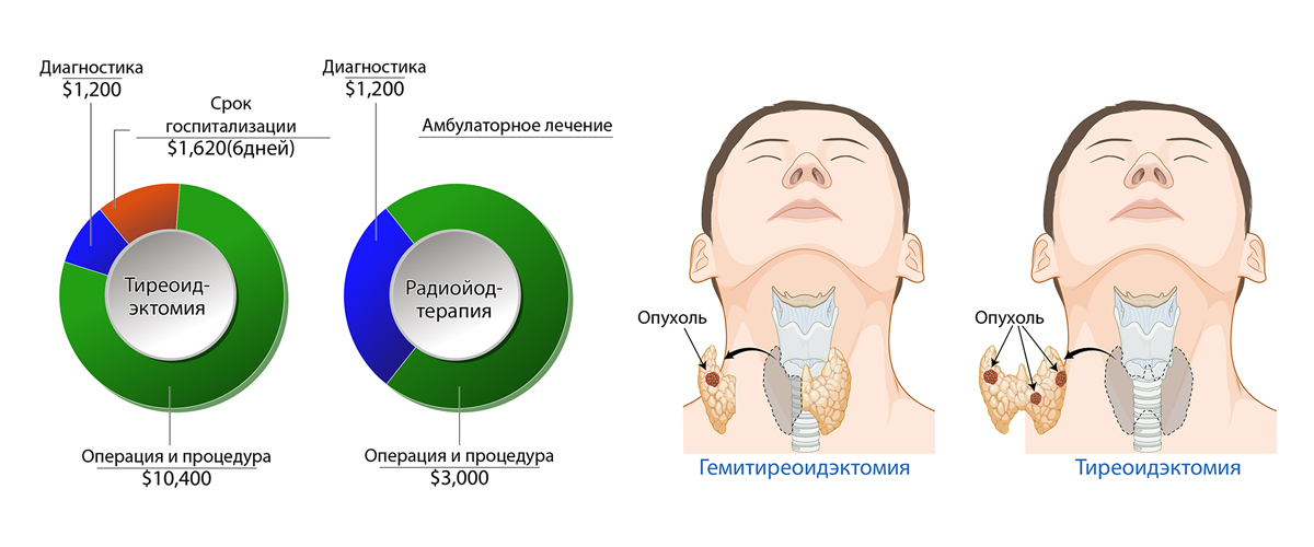 Рак щитовидной железы