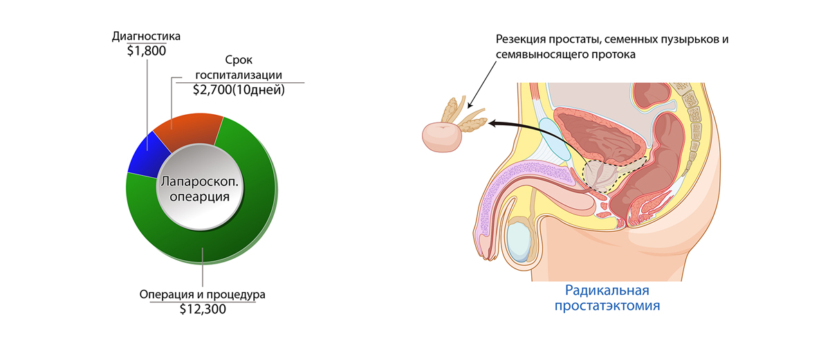 Рак предстательной железы