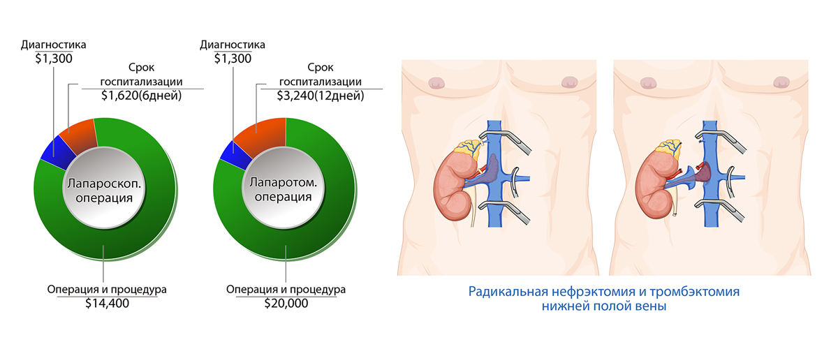 Рак почки