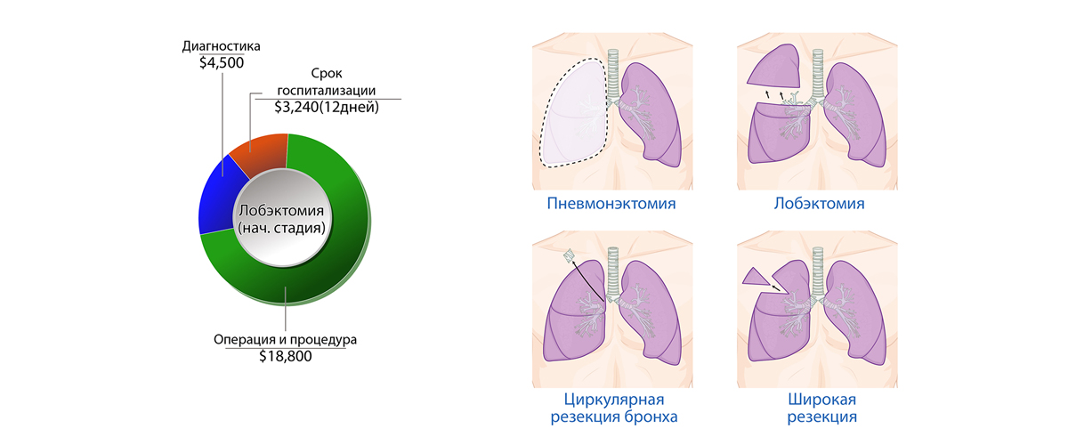 Рак лёгких