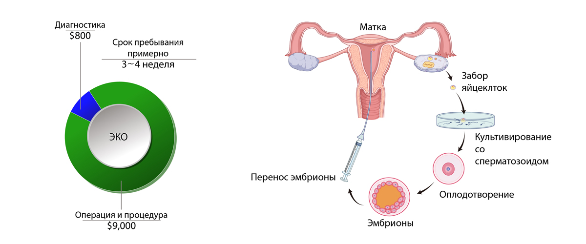 Экстракорпоральное оплодотворение и перенос эмбрионов