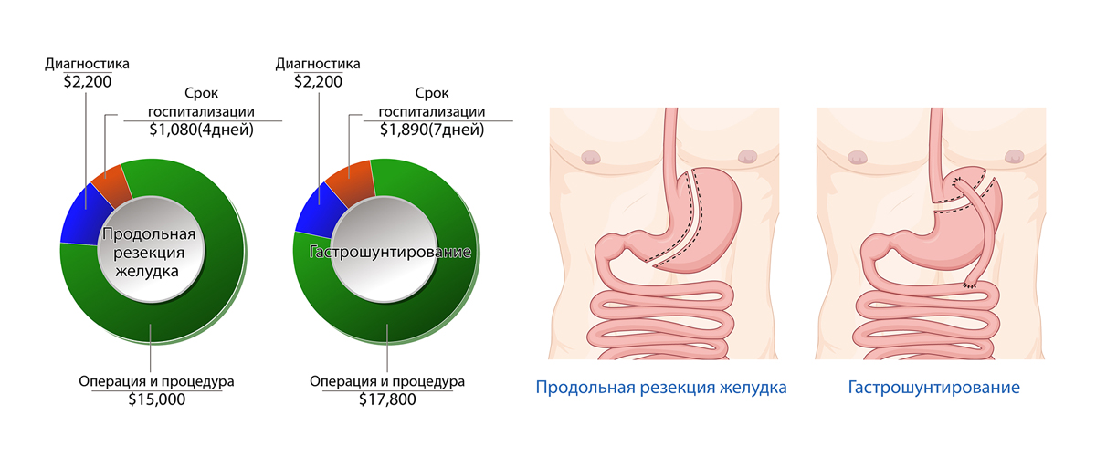 Метаболическая (бариатрическая) операция